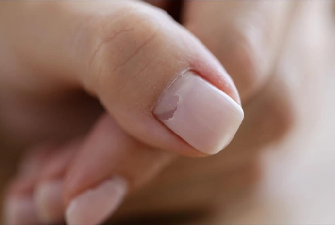 Ongle cassé